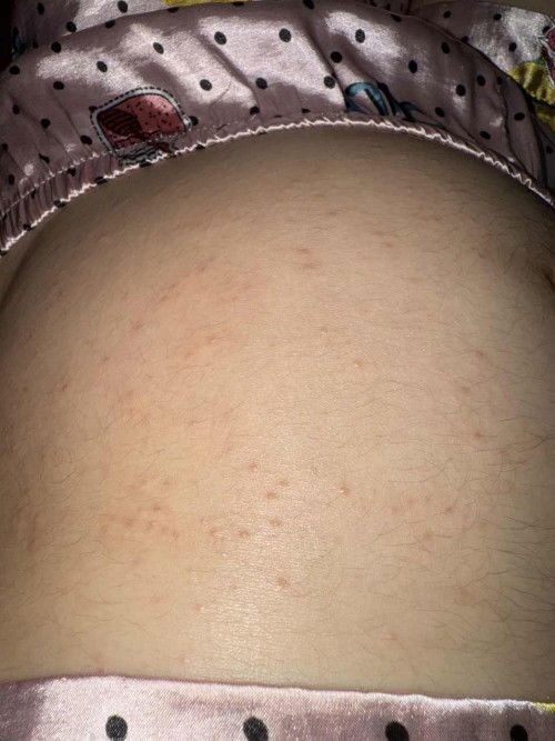 ผื่นคันที่ท้อง 22+1 Wk