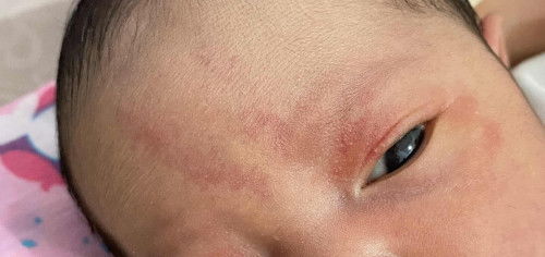 Bintik merah pada newborn