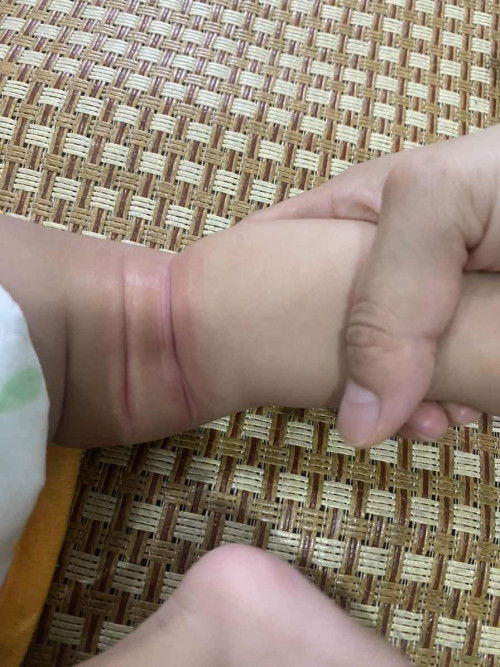Nhà mom nào có bé bị như này giống con e k ạ..bôi gì cho hết v ạ.