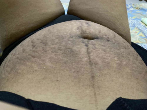 Ngilangin stretch mark