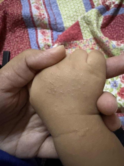 Biji air di tgn dan kaki