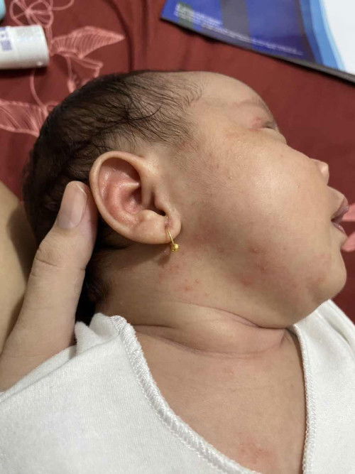 Bintik merah pada newborn