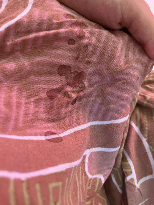 Keluar cairan pada payudara