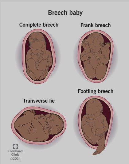 Breech Position