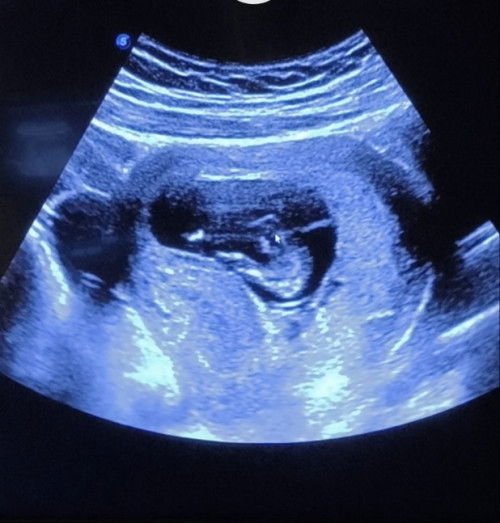 Gender baby