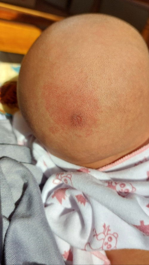 Kepala bayi pitak