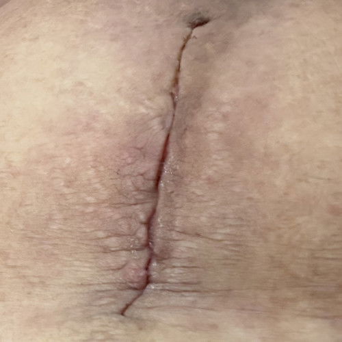 REPEAT CS INCISION