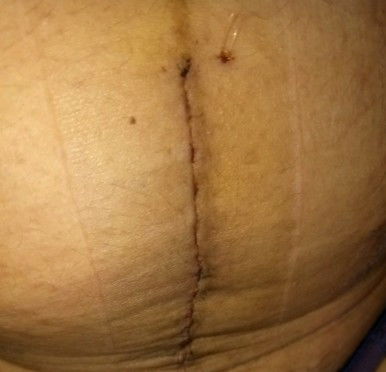Post op E-CS