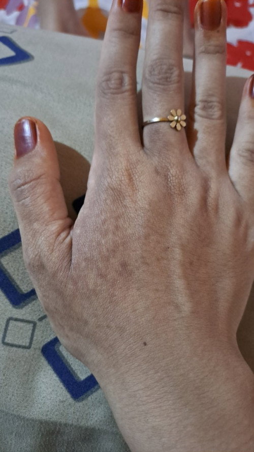 Flek hitam di tangan