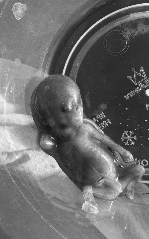 Baby IUCD complete miscarriage 13w