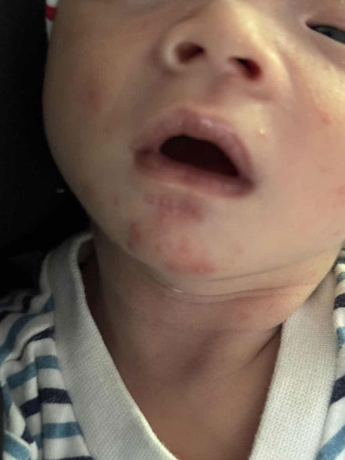 Bintik2 merah seperti Ruam pada baby