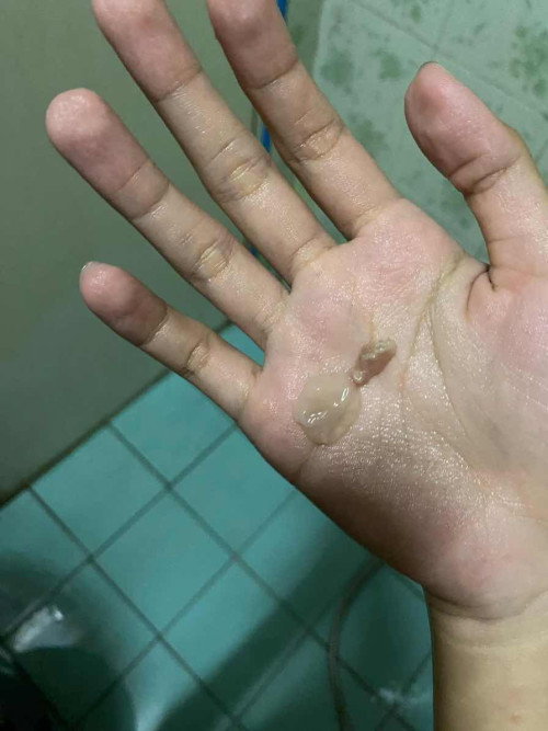 แม่ๆคะ อันนี้ออกมาจากช่องคลอดคะเสี่ยงแท้งหรือเป็นอะไรมั้ยคะ