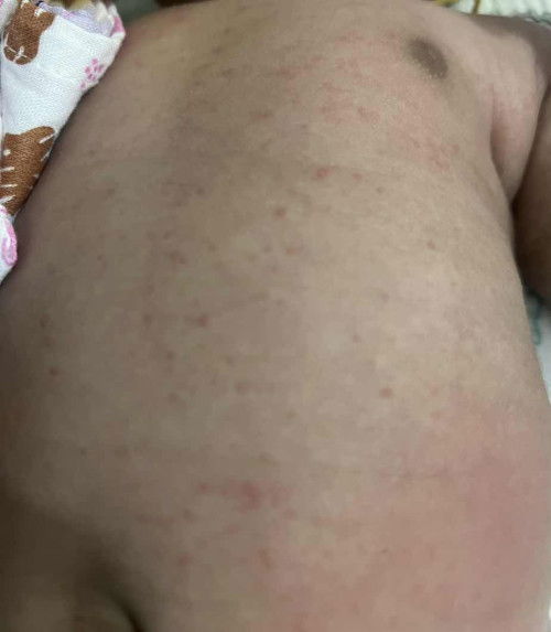 ผื่นแดง แม่ๆบ้านไหนลูกเคยเป็นแบบนี้ไหมคะ