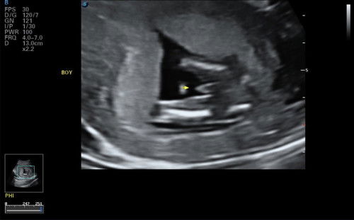gender scan 15weeks