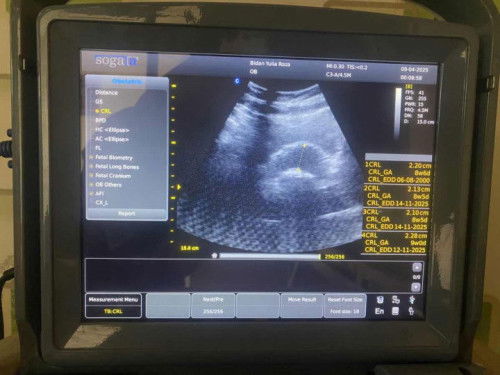 Kandungan 9week, kondisi keluar darah seperti haid. Apa harus BEDREST ??