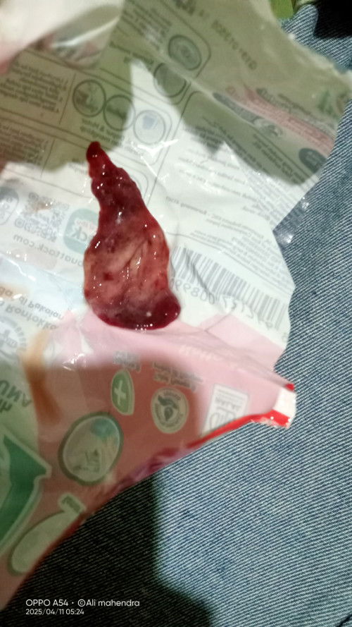 Saya ingin tanya saya sedang haid tiba tiba keluar gumpalan darah berwarna putih campur merah