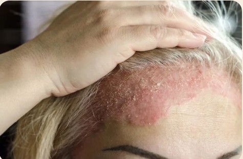 Best Dermatologist For Eczema Treatment