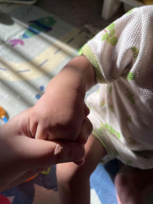 Bintik bintik kecil di kaki dan tangan