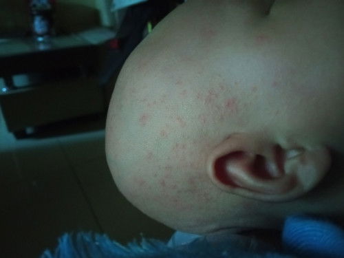 Obat bruntusan di kepala bayi