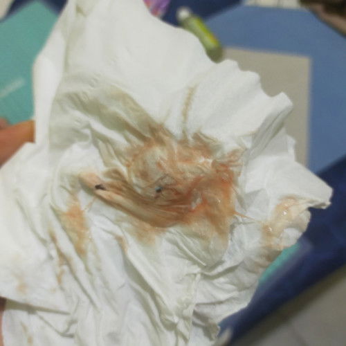 Tentang setelah pasang KB iud