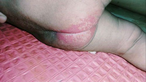 ruam di pantat bayi
