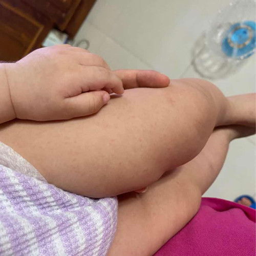 Bé nhà e bị sốt 2 ngày sau đó tự hạ một ngày hôm nay bị sốt lại và nổi chấm như thế các mẹ cho e xin