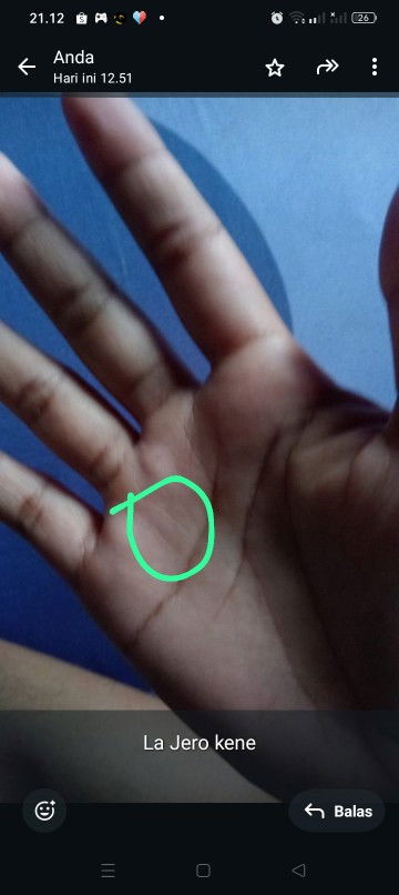 Bun kalo bagian tangan ini ada benjolan seperti tulang kenapa ya,kalo benjolan diteken sakit rasanya