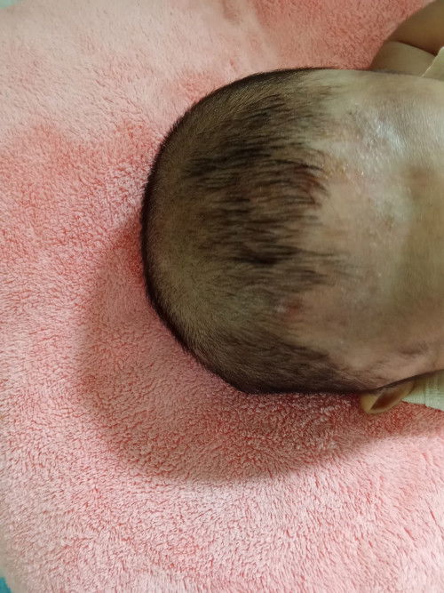 Kulit kepala bayi 3 bulan bernanah dan berkerak