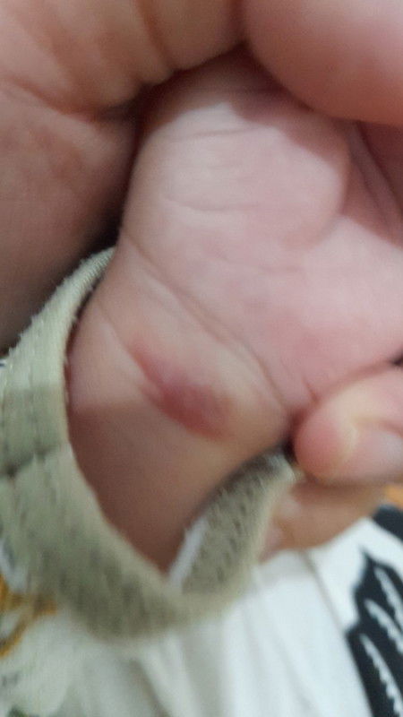 Bunda2mau nanya dong kalau debay umur2 bln melenting trus jdi bentol merah pakai obat apa ya?