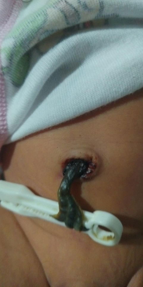 UMBILICAL CORD/ PUSOD