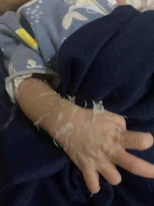 kulit newborn kelupas dari wajah ke kaki