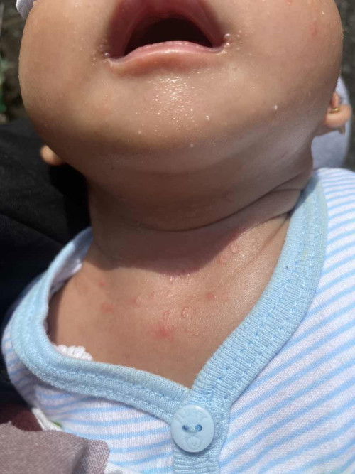 Bintik merah newborn