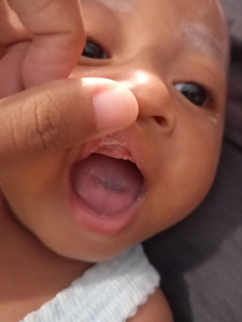 Bercak putih ddi bibir