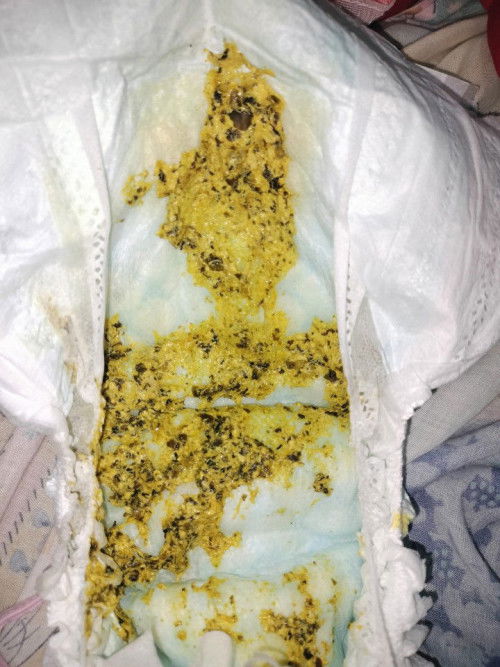 Diarrhea po ba ito? (May black yung poops ng lo ko kasi nagte take siya ng iron)