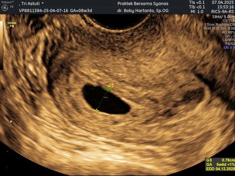 Bunda bunda adakah yang ngalamin juga seperti sya ??