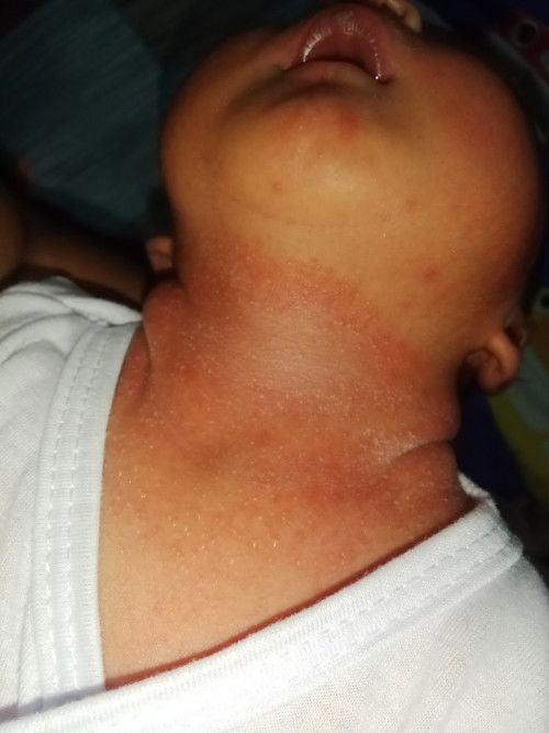 Mga mii ano po kaya tong Maliliit na butlig ni LO ? possible po kayang san nakukuha to ?