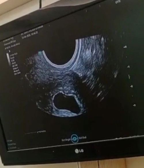 Bun hamil 8 minggu masih terlihat kantungnya sajaa? Wajar gak sih bun