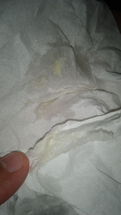 Ini keputihan apa lendir