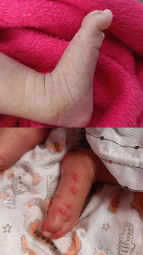 Bintik merah pada bayi