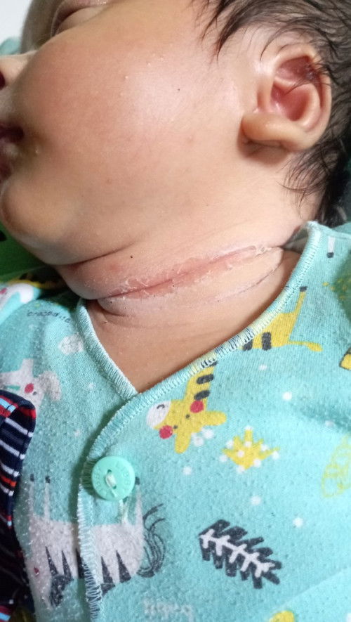 leher newborn lecet