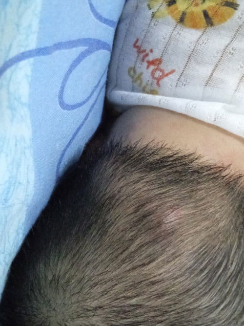 Bisul di kepala bayi