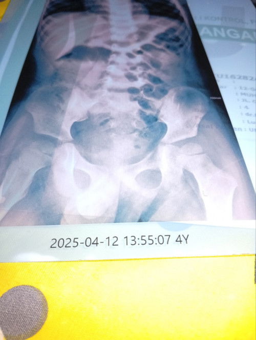 Tulang retak anak 4thn