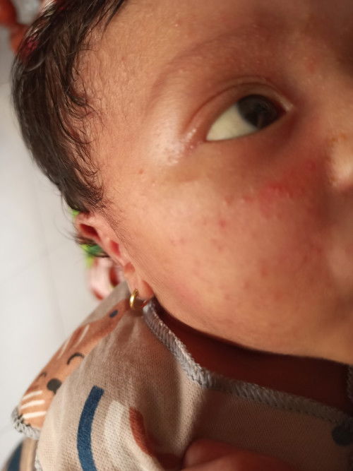 Bruntusan merah dan kuning