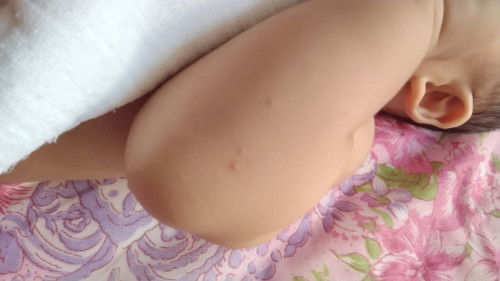 Baby 5m15d naik bintik di legan