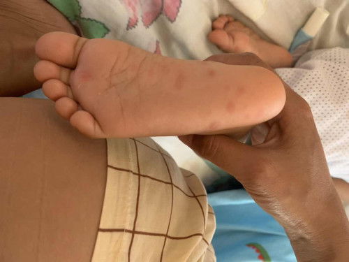 Butlig sa paa at puwet ng baby ko