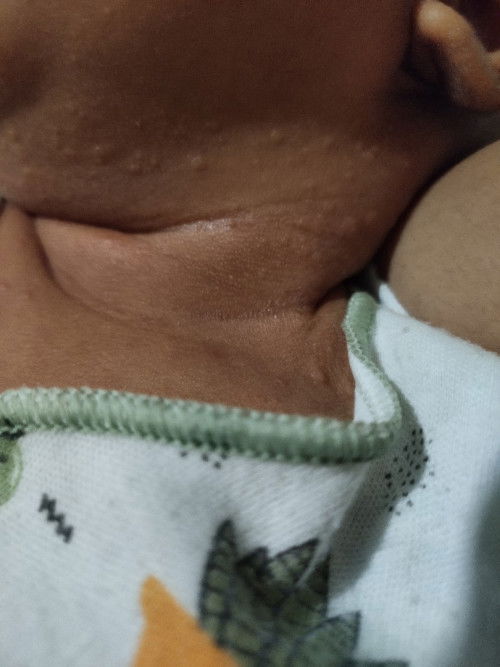 Cara mengatasi gatal bintik kemerahan pada bayi bagaiamana ya?