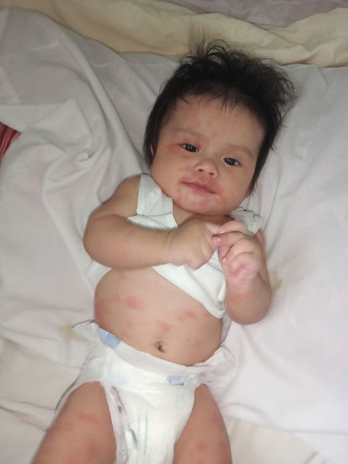 Ano pong pwede gatas ni baby 4months old po sya sa bonna at nestogen po nagkaka pula pula po sya?