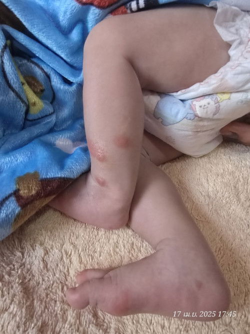 เจ็บเต้านม