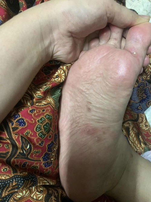 Ada tak kat sini prggy tm3 yg kulit gatal mcm ni.. pakai apa ye.. dah pakai calamine losyen x ok jgk