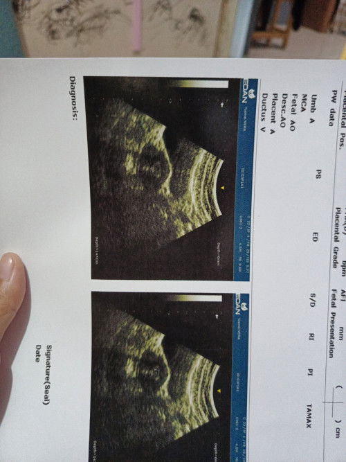 Hasil USG